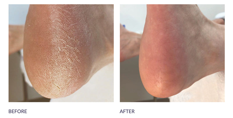 Ultimate 'At Home' Foot Care Combo