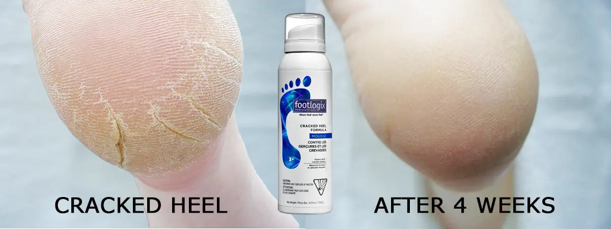 Cracked Heel Formula