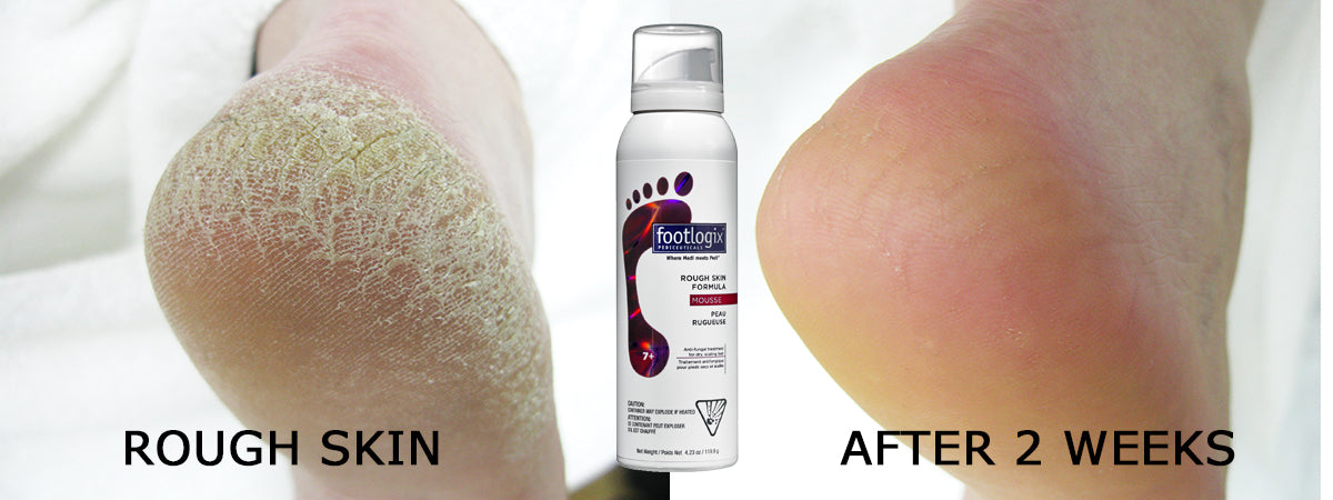 Rough Skin Formula
