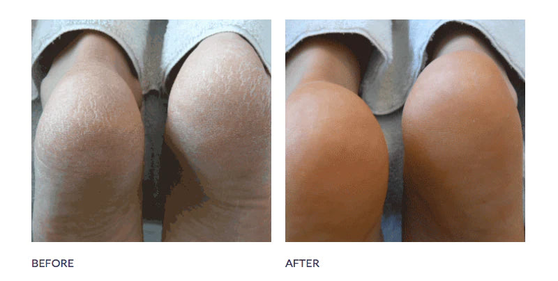 Very Dry Skin Formula