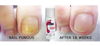 Anti-Fungal Nail Tincture